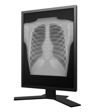 a chest radiography image on a single medical display