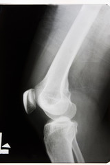X-rayed the leg and knee