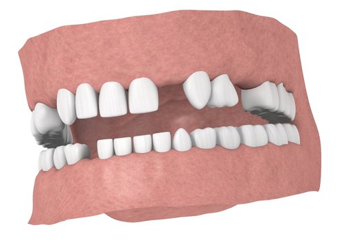 3d render of human teeth without some teeths