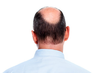 Obraz premium Hair loss. Bald man.