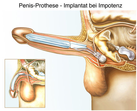 Penis-Prothese.Implantat bei Impotenz