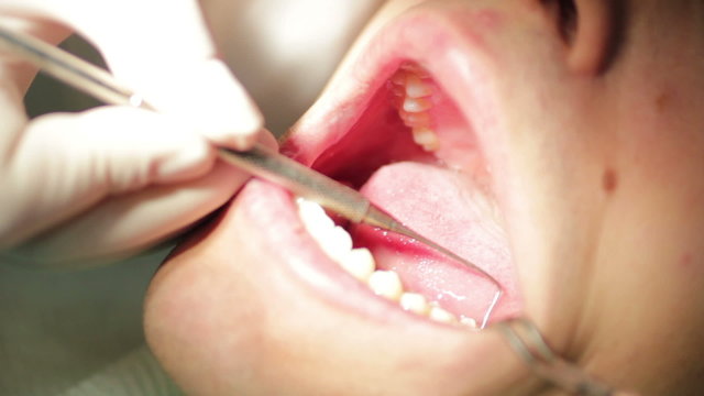 Close-up of patient open mouth during oral checkup