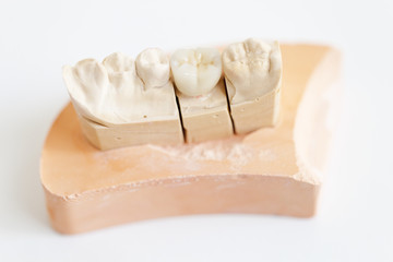 couronne en céramique