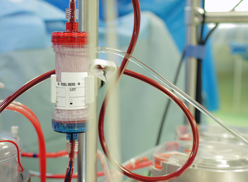 Ultrafiltration During Cardiopulmonary Bypass.