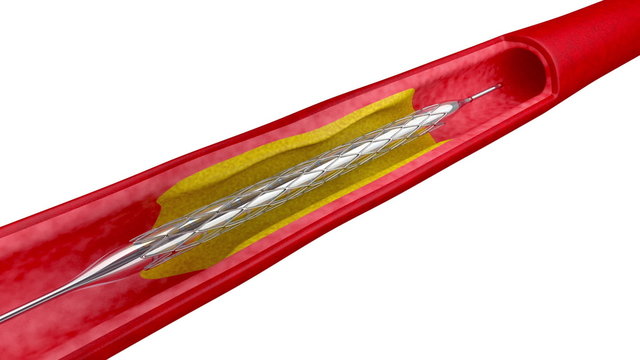 Angioplasty