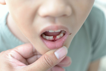 Fototapeta premium Loss milk tooth