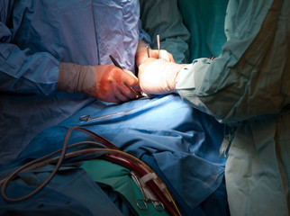 Surgeon hands during operation