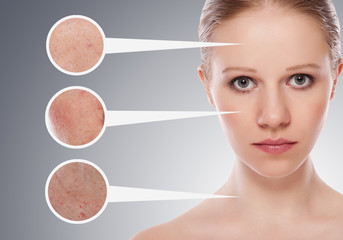 concept skincare. Skin of beauty young woman before and after th
