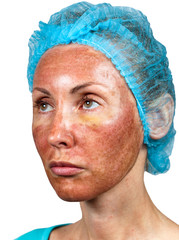 Cosmetology. Skin condition after chemical peeling TCA. - 42052905