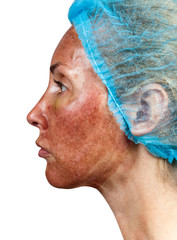 Cosmetology.Skin condition after chemical peeling TCA.