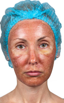 Cosmetology. Skin condition after chemical peeling TCA.