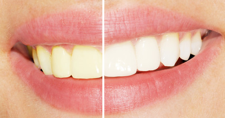 Woman teeth before and after whitening