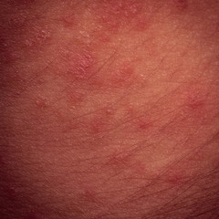 eczema atopic dermatitis symptom skin texture