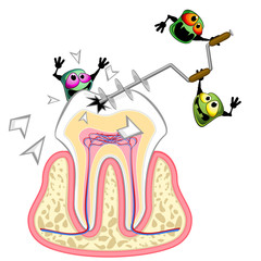 Germs drilling tooth