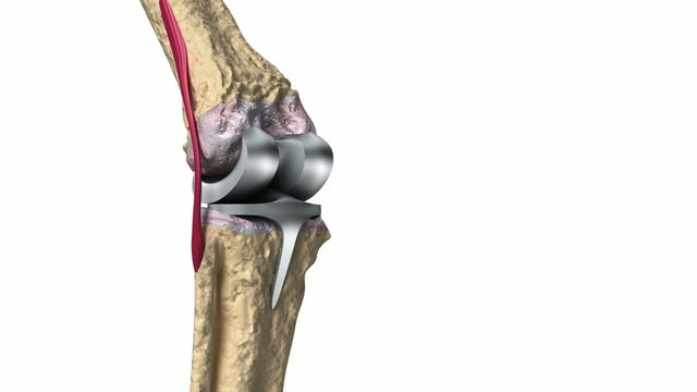 Knee and titanium hinge joint process