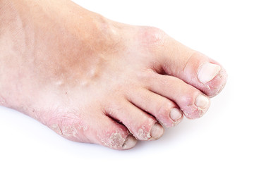 single male foot with eczema isolated on white background