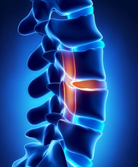Herniated disc with pressure on spinal cord - obrazy, fototapety, plakaty