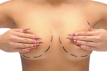 Closeup photo of a Caucasian woman's breasts marked