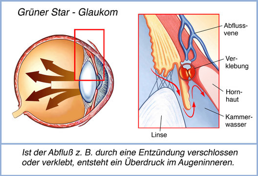 Der grüne Star.Überdruck.Glaukom