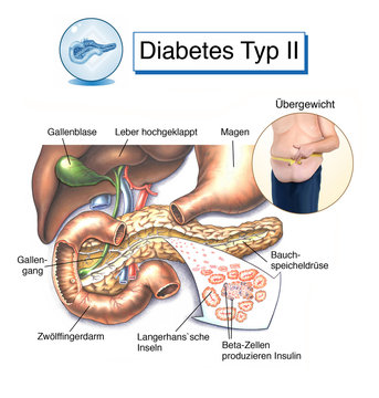 Bauchspeicheldr&uuml;se.Diabetes Typ II