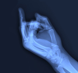 X-ray of the middle finger.