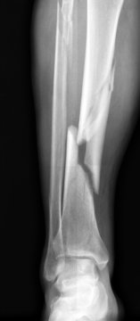 X-ray of broken leg.