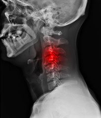 X-ray of neck. - obrazy, fototapety, plakaty