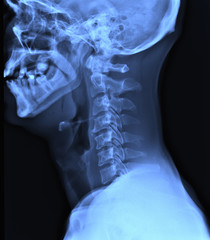 X-ray of neck.