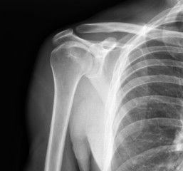 X-ray of shoulder joint.