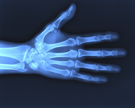 X-ray hand