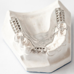 Lower partial denture with attachments