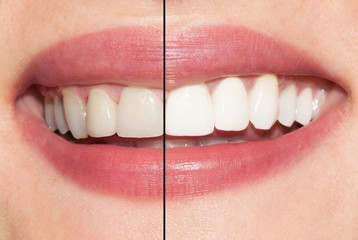 Woman teeth before and after whitening.