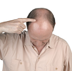 Human hair loss - adult man hand pointing his bald head