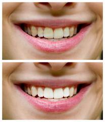 Bleaching - Before, after