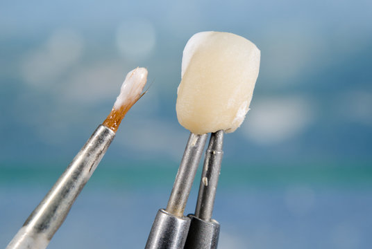applying ceramic material on dental crown