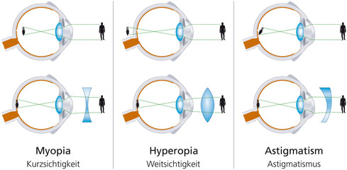 myopia asztigmatizmus hyperopia