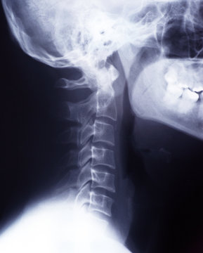 Röntgenbild Halswirbelsäule Wirbelsäule - Schädel Knochen