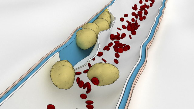 Coronary embolus travels through the circulatory system