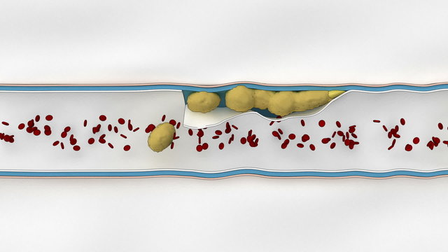 Coronary embolus in circulatory system