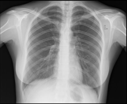 A chest x-ray image