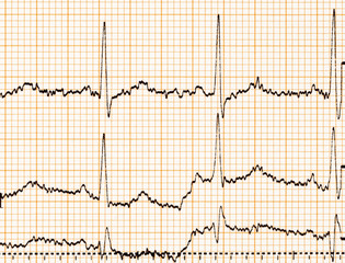 ECG paper