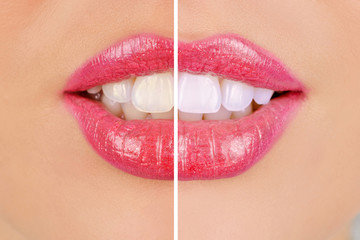 Naklejka premium whitening