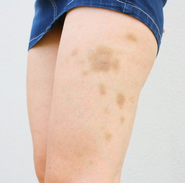 ecchymoses sur jambe