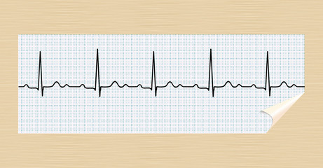 Normal ECG. Realistic vector.