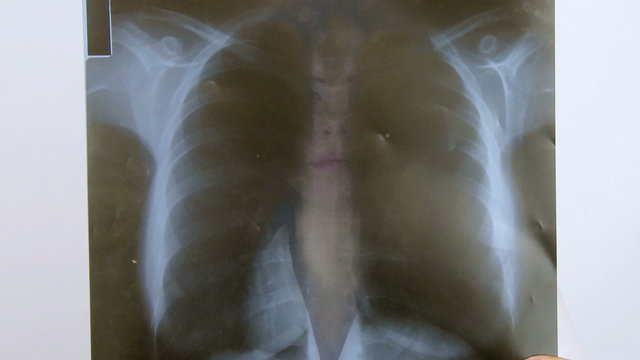 Doctor looking lung x ray cancer