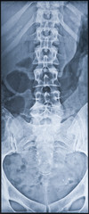 Back X-ray including coxis and pelvis. Female.