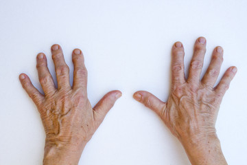 Closeup of senior hands with strong arthritis