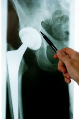 R&ouml;ntgenbild - Endoprothese