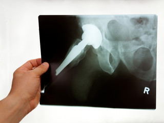 K&uuml;nstliches H&uuml;ftgelenk im R&ouml;ntgenbild