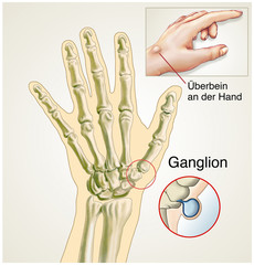 Ganglion.Überbein an der Hand